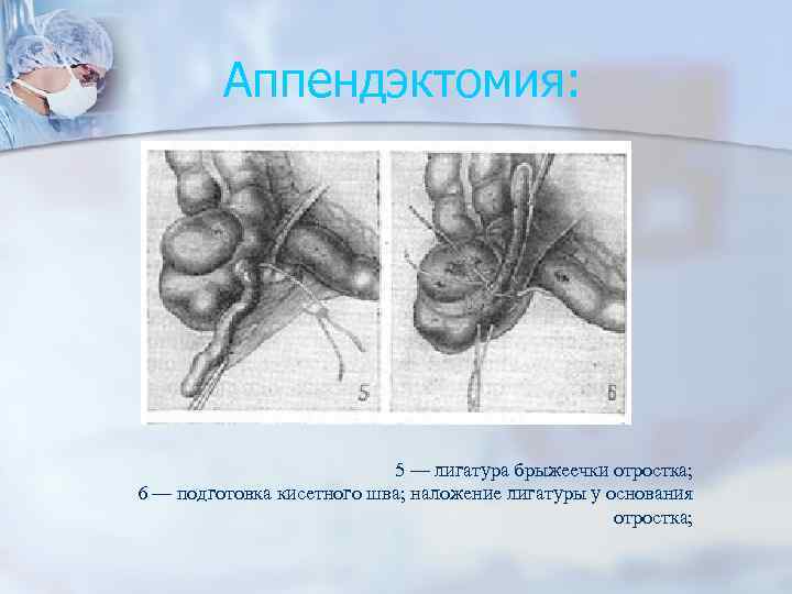 Аппендэктомия: 5 — лигатура брыжеечки отростка; 6 — подготовка кисетного шва; наложение лигатуры у