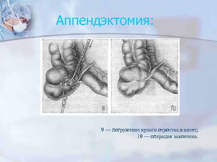 Аппендэктомия: 9 — погружение культи отростка в кисет; 10 — операция закончена. 