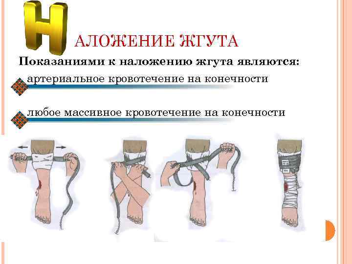 АЛОЖЕНИЕ ЖГУТА Показаниями к наложению жгута являются: артериальное кровотечение на конечности любое массивное кровотечение