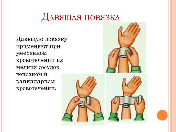 ДАВЯЩАЯ ПОВЯЗКА Давящую повязку применяют при умеренном кровотечении из мелких сосудов, венозном и капиллярном