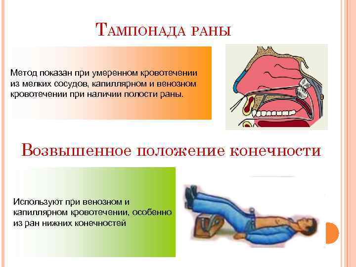 ТАМПОНАДА РАНЫ Метод показан при умеренном кровотечении из мелких сосудов, капиллярном и венозном кровотечении