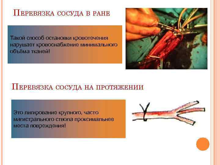 ПЕРЕВЯЗКА СОСУДА В РАНЕ Такой способ остановки кровотечения нарушает кровоснабжение минимального объёма тканей! ПЕРЕВЯЗКА