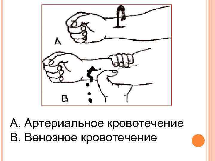 А. Артериальное кровотечение В. Венозное кровотечение 