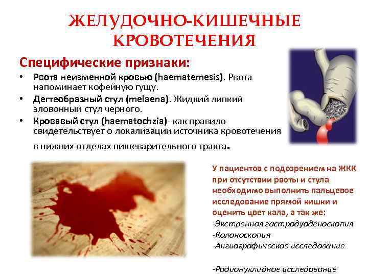 ЖЕЛУДОЧНО-КИШЕЧНЫЕ КРОВОТЕЧЕНИЯ Специфические признаки: • Рвота неизменной кровью (haematemesis). Рвота напоминает кофейную гущу. •
