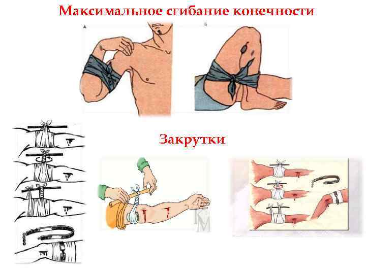 Максимальное сгибание конечности Закрутки 