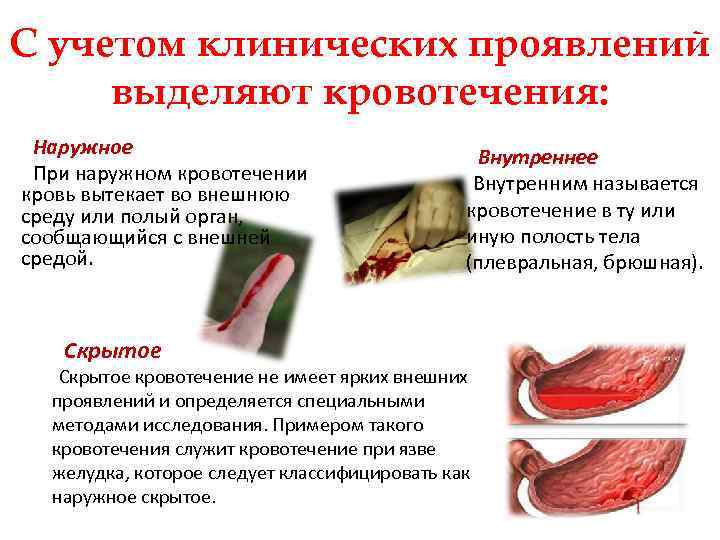 С учетом клинических проявлений выделяют кровотечения: Наружное При наружном кровотечении кровь вытекает во внешнюю