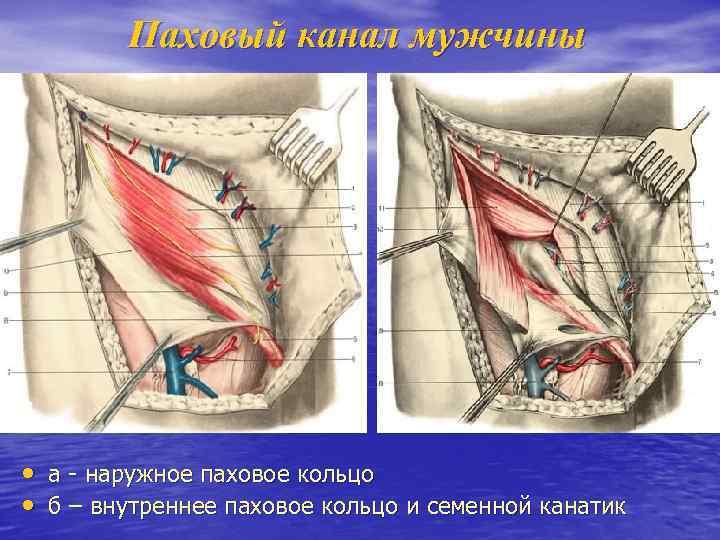 Паховый канал мужчины • а - наружное паховое кольцо • б – внутреннее паховое