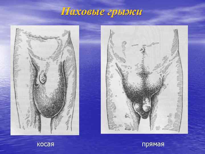 Паховые грыжи косая прямая 