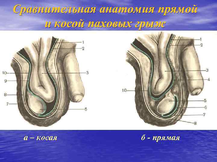 Сравнительная анатомия прямой и косой паховых грыж а – косая б - прямая 