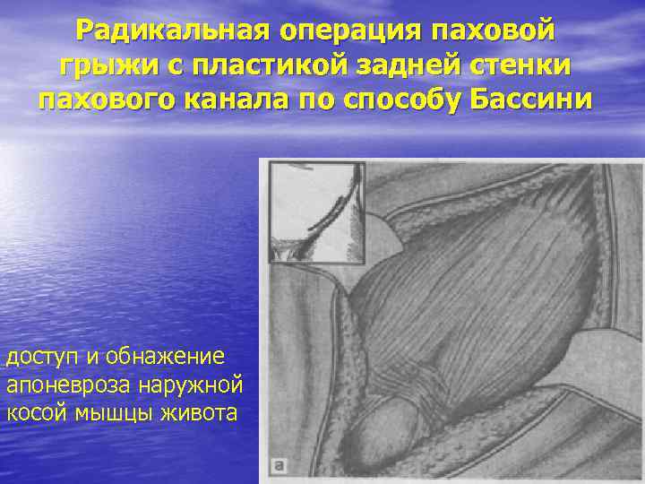 Радикальная операция паховой грыжи с пластикой задней стенки пахового канала по способу Бассини доступ