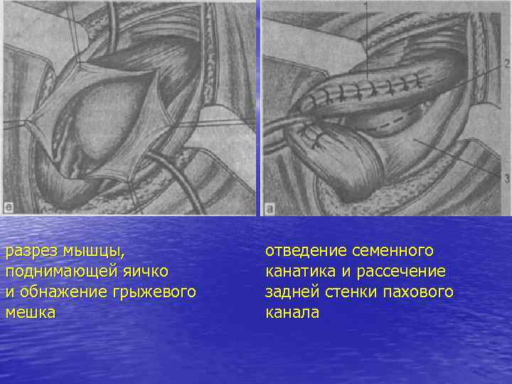 разрез мышцы, поднимающей яичко и обнажение грыжевого мешка отведение семенного канатика и рассечение задней