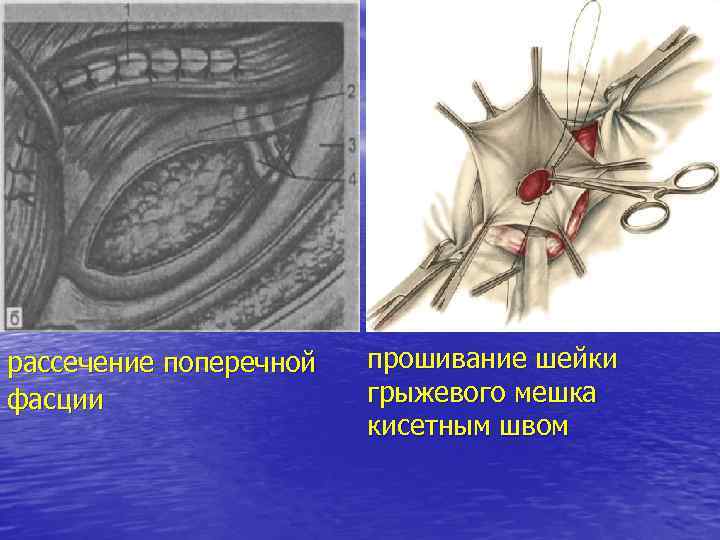 рассечение поперечной фасции прошивание шейки грыжевого мешка кисетным швом 