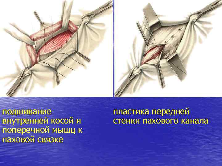 подшивание внутренней косой и поперечной мышц к паховой связке пластика передней стенки пахового канала