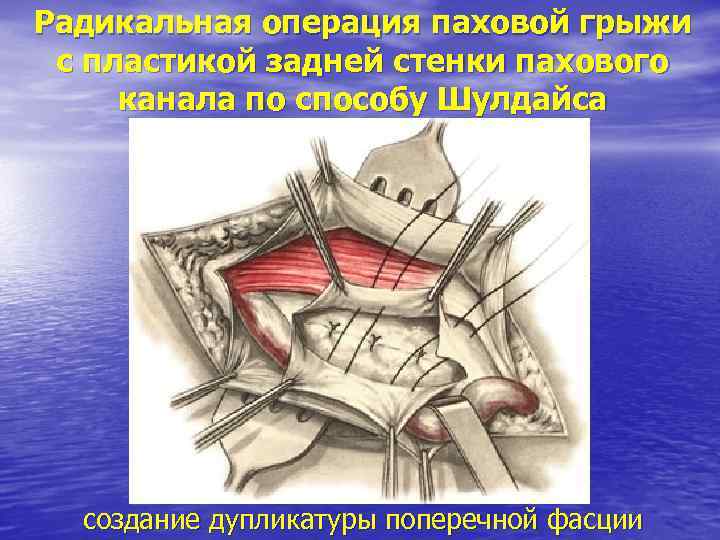 Радикальная операция паховой грыжи с пластикой задней стенки пахового канала по способу Шулдайса создание