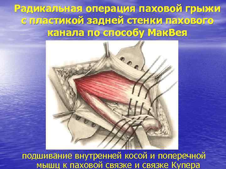 Радикальная операция паховой грыжи с пластикой задней стенки пахового канала по способу Мак. Вея