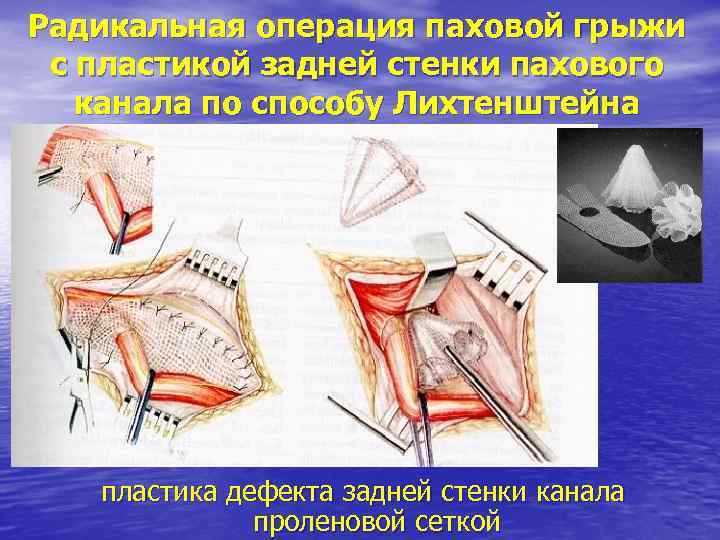 Радикальная операция паховой грыжи с пластикой задней стенки пахового канала по способу Лихтенштейна пластика