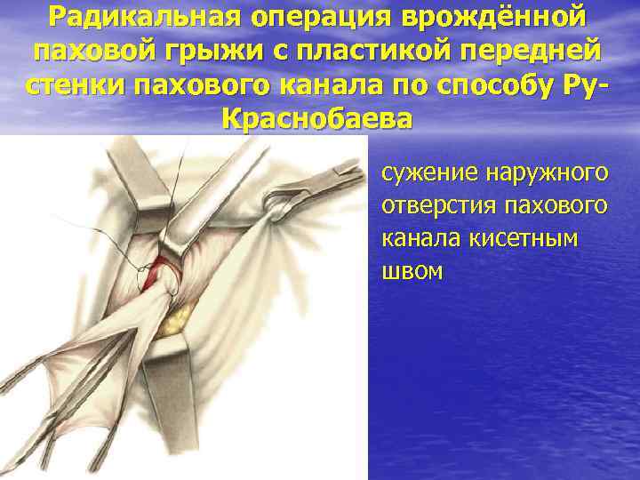 Радикальная операция врождённой паховой грыжи с пластикой передней стенки пахового канала по способу Ру.