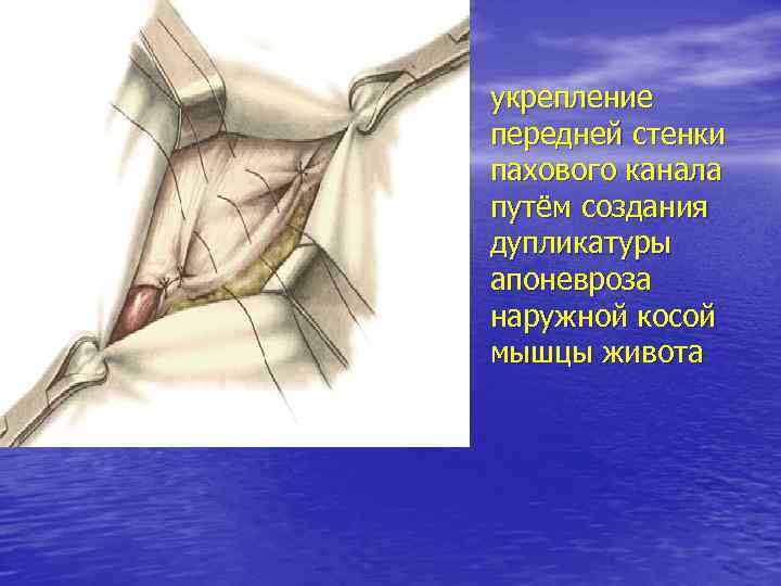 укрепление передней стенки пахового канала путём создания дупликатуры апоневроза наружной косой мышцы живота 