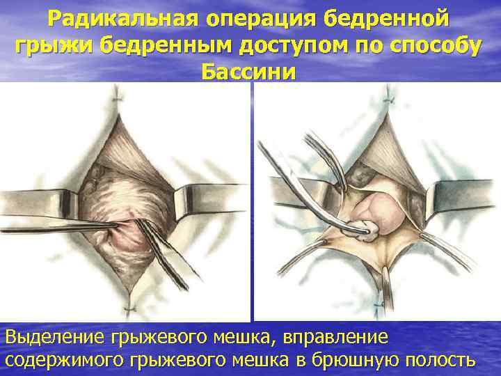Радикальная операция бедренной грыжи бедренным доступом по способу Бассини Выделение грыжевого мешка, вправление содержимого