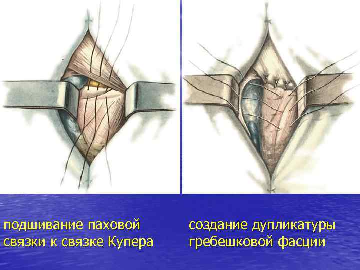 подшивание паховой связки к связке Купера создание дупликатуры гребешковой фасции 