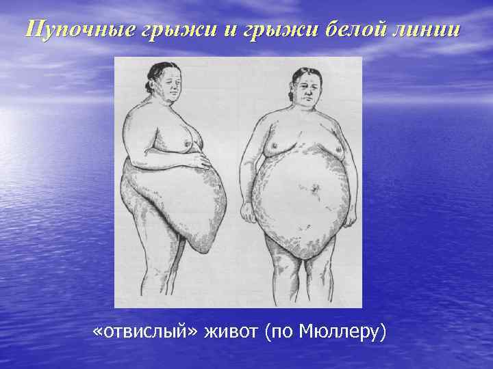 Пупочные грыжи и грыжи белой линии «отвислый» живот (по Мюллеру) 