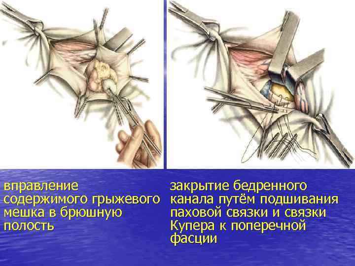 вправление содержимого грыжевого мешка в брюшную полость закрытие бедренного канала путём подшивания паховой связки