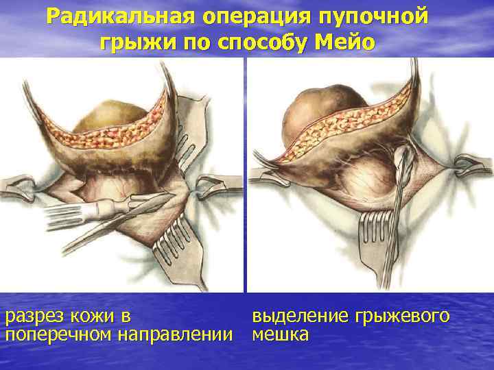Радикальная операция пупочной грыжи по способу Мейо разрез кожи в выделение грыжевого поперечном направлении