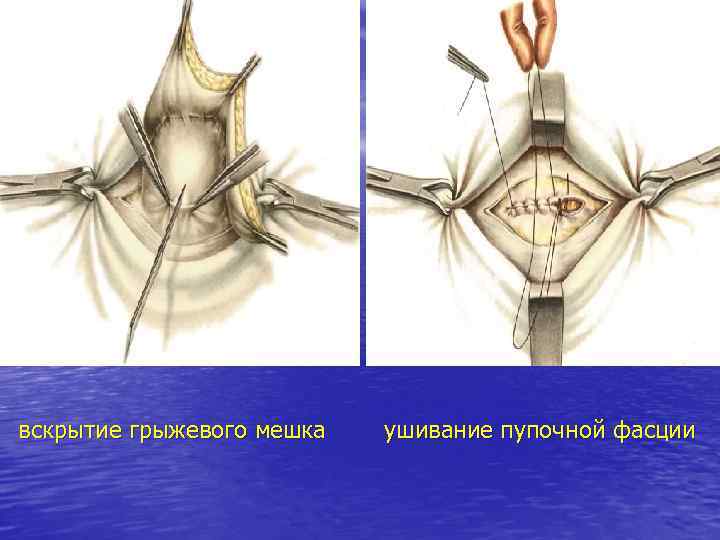вскрытие грыжевого мешка ушивание пупочной фасции 