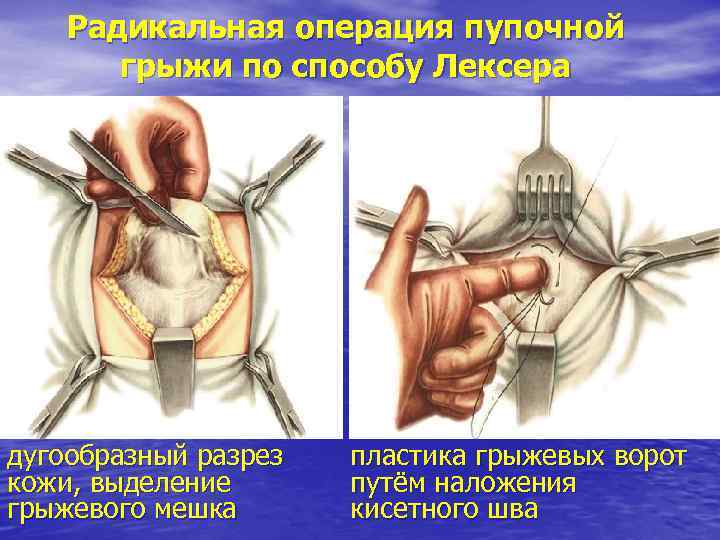 Радикальная операция пупочной грыжи по способу Лексера дугообразный разрез кожи, выделение грыжевого мешка пластика