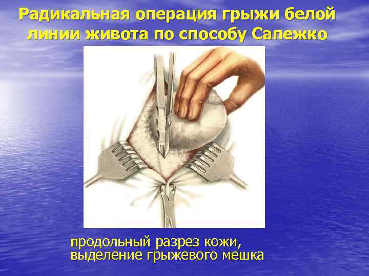 Радикальная операция грыжи белой линии живота по способу Сапежко продольный разрез кожи, выделение грыжевого