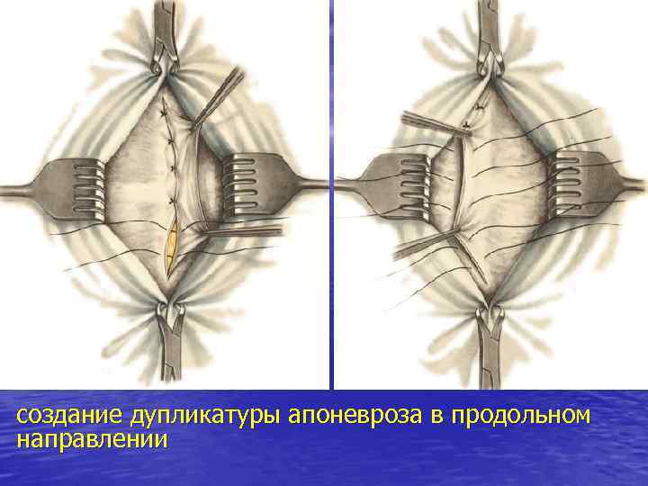 создание дупликатуры апоневроза в продольном направлении 