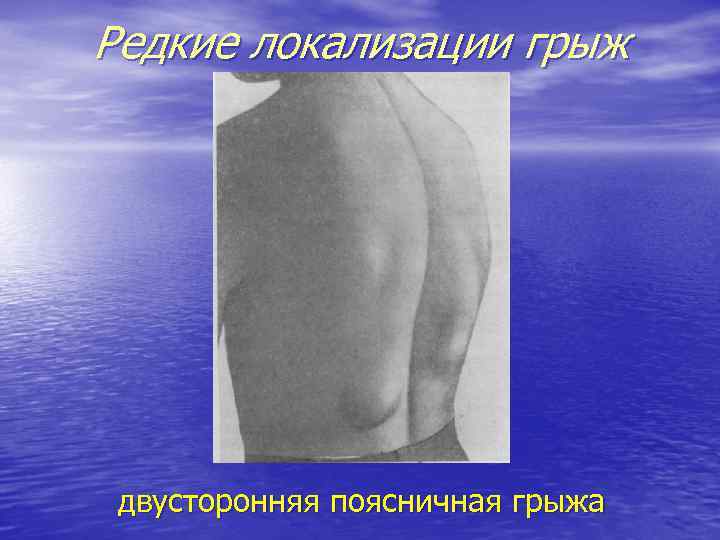 Редкие локализации грыж двусторонняя поясничная грыжа 