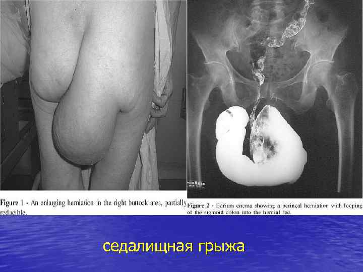 седалищная грыжа 