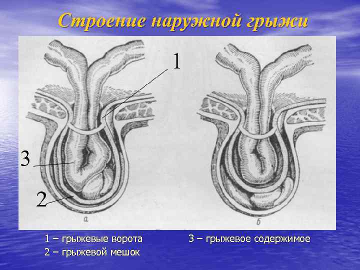Строение наружной грыжи 1 – грыжевые ворота 2 – грыжевой мешок 3 – грыжевое