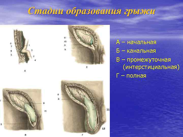 Стадии образования грыжи А – начальная Б – канальная В – промежуточная (интерстициальная) Г