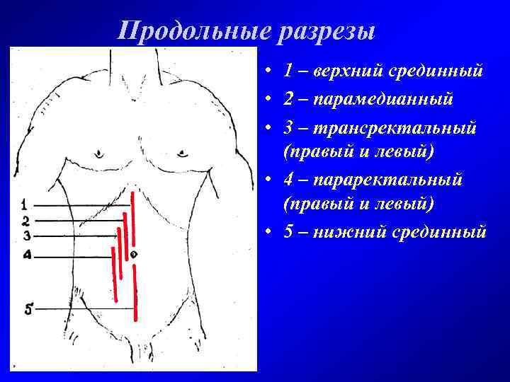 Продольные разрезы • 1 – верхний срединный • 2 – парамедианный • 3 –