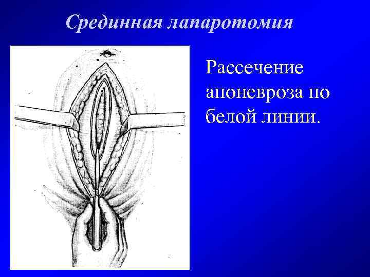 Срединная лапаротомия Рассечение апоневроза по белой линии. 