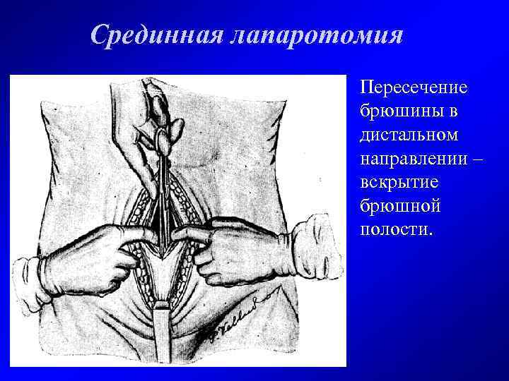 Срединная лапаротомия Пересечение брюшины в дистальном направлении – вскрытие брюшной полости. 