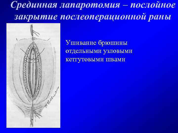 Срединная лапаротомия – послойное закрытие послеоперационной раны Ушивание брюшины отдельными узловыми кетгутовыми швами 