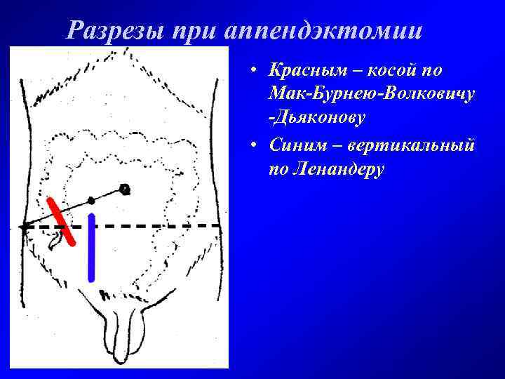 Разрезы при аппендэктомии • Красным – косой по Мак-Бурнею-Волковичу -Дьяконову • Синим – вертикальный