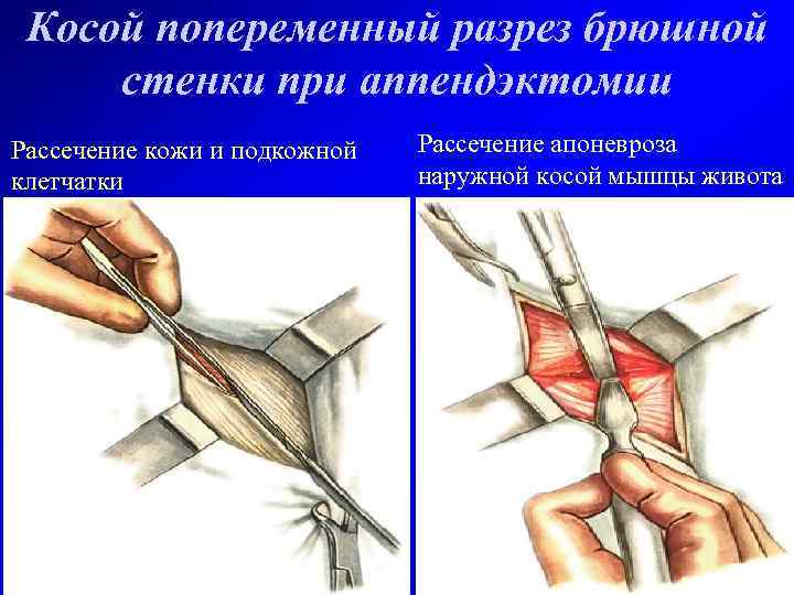 Косой попеременный разрез брюшной стенки при аппендэктомии Рассечение кожи и подкожной клетчатки Рассечение апоневроза