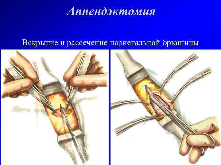Аппендэктомия Вскрытие и рассечение париетальной брюшины 
