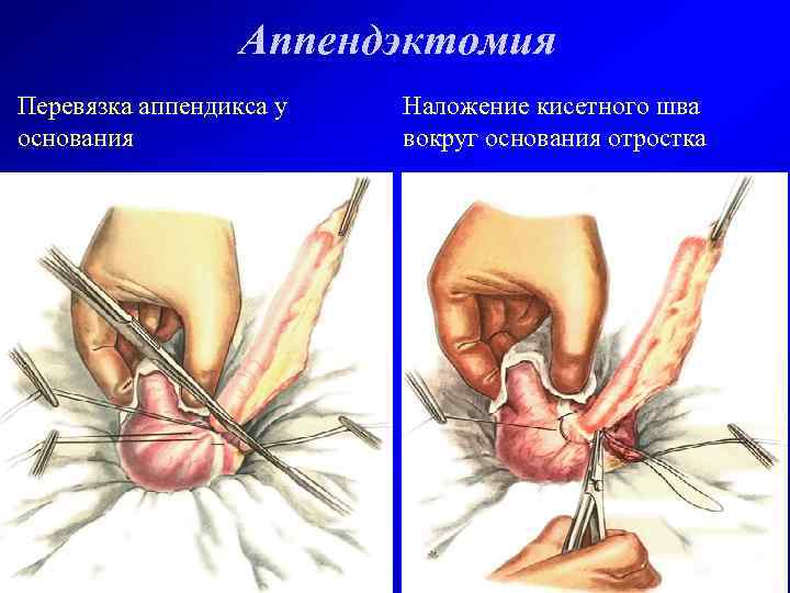 Аппендэктомия Перевязка аппендикса у основания Наложение кисетного шва вокруг основания отростка 