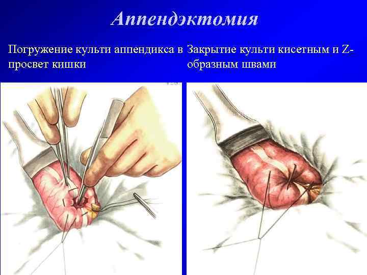 Аппендэктомия Погружение культи аппендикса в Закрытие культи кисетным и Zпросвет кишки образным швами 