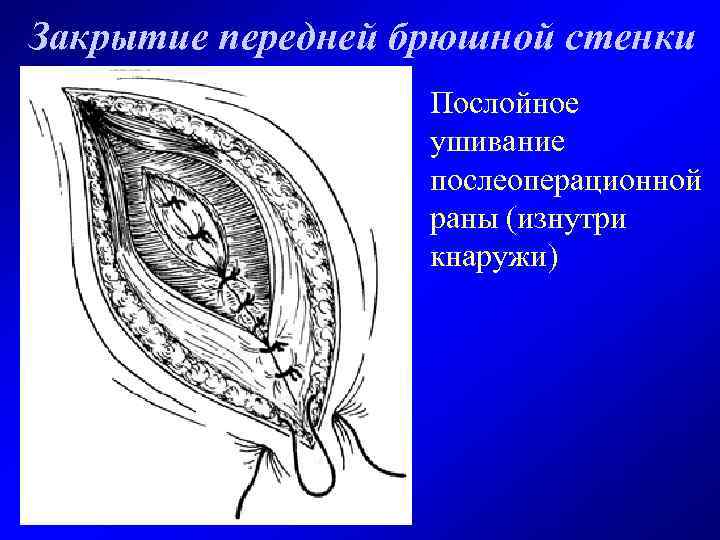 Закрытие передней брюшной стенки Послойное ушивание послеоперационной раны (изнутри кнаружи) 