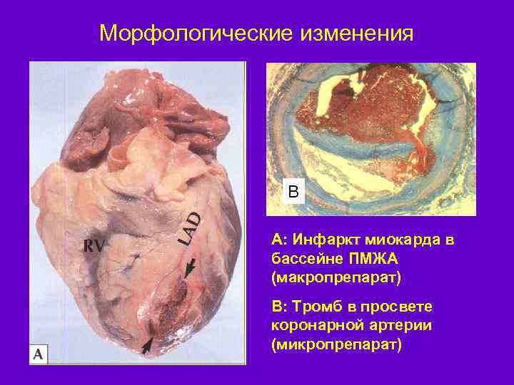 Морфологические изменения B А: Инфаркт миокарда в бассейне ПМЖА (макропрепарат) B: Тромб в просвете