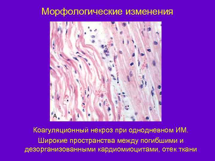 Морфологические изменения. Коагуляционный некроз инфаркт миокарда. Коагуляционный некроз гистология. Некроз кардиомиоцитов микропрепарат. Некроз кардиомиоцитов при инфаркте миокарда.