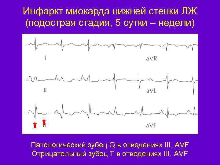 Инфаркт миокарда нижней стенки ЛЖ (подострая стадия, 5 сутки – недели) Патологический зубец Q