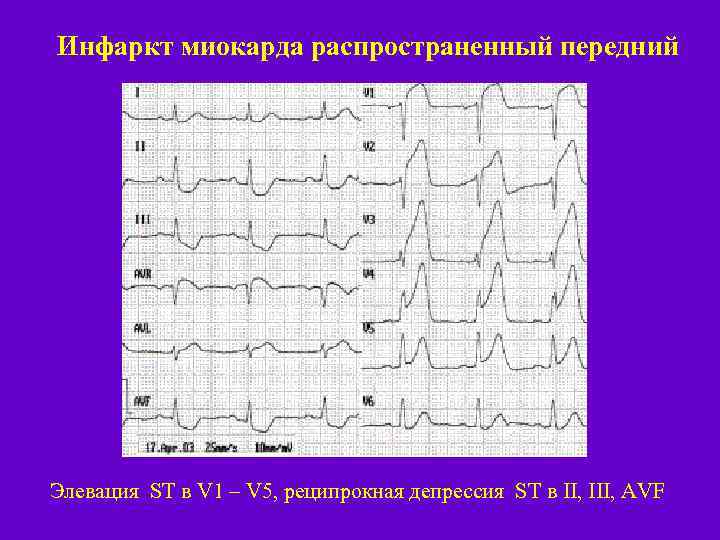 Инфаркт миокарда распространенный передний Элевация ST в V 1 – V 5, реципрокная депрессия