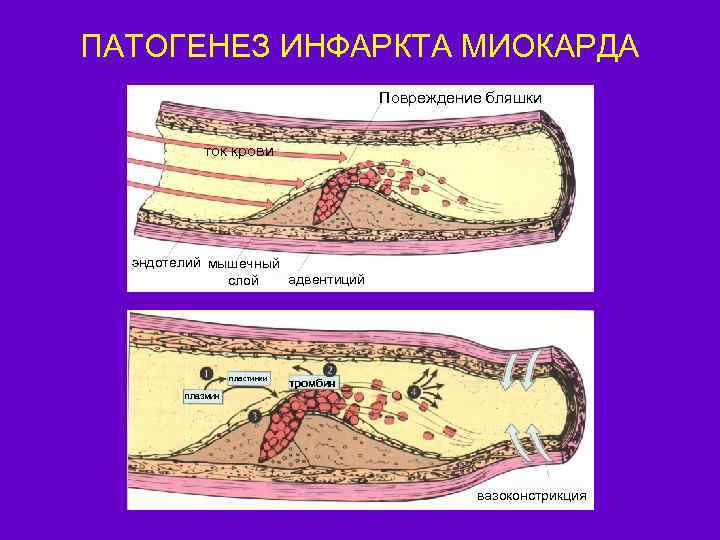 ПАТОГЕНЕЗ ИНФАРКТА МИОКАРДА Повреждение бляшки ток крови эндотелий мышечный адвентиций слой пластинки тромбин плазмин